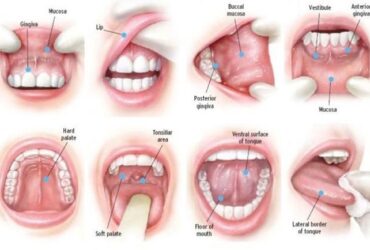 mouth sores